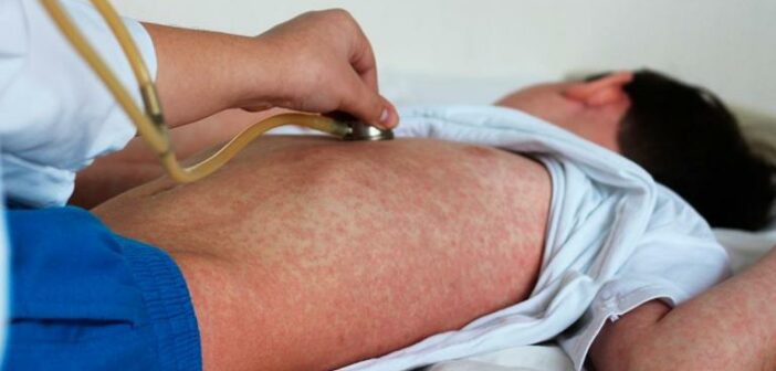 26 muertes y más de 7 mil casos de sarampión en México, confirma reporte epidemiológico 26 muertes y más de 7 mil casos de sarampión en México, confirma reporte epidemiológico