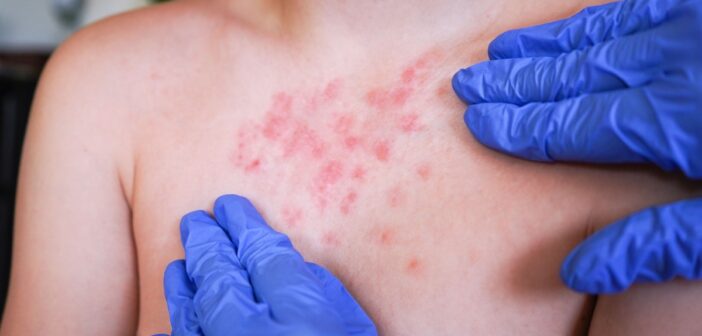 Repuntan a 15 los casos de sarampión en Veracruz, confirma IMSS-Bienestar